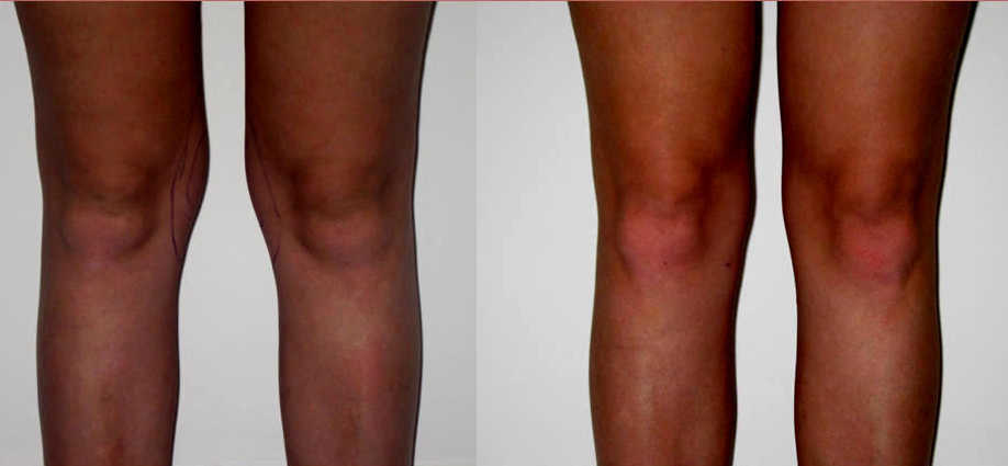 liposuccion de rodillas antes y después: grasa en las rodillas gruesas antes de la cirugía