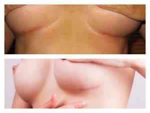 imágenes mostrando cicatrices bajo el pecho tras una cirugía de aumento de pechos