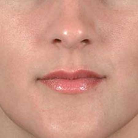 rellenos faciales de labios en Valencia Dr. Puig