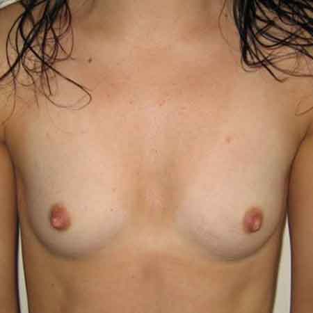 mamoplastia de aumento Dr. Puig