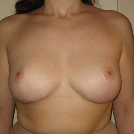 mamoplastia de reducción en Gandía Dr. Puig