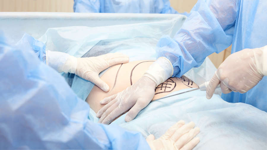 Postoperatorio de abdominoplastia: cuidados y complicaciones - Clínica  Londres