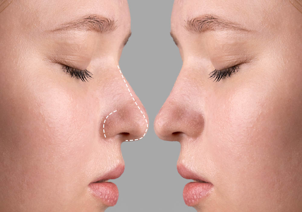rinoplastia precio en valencia