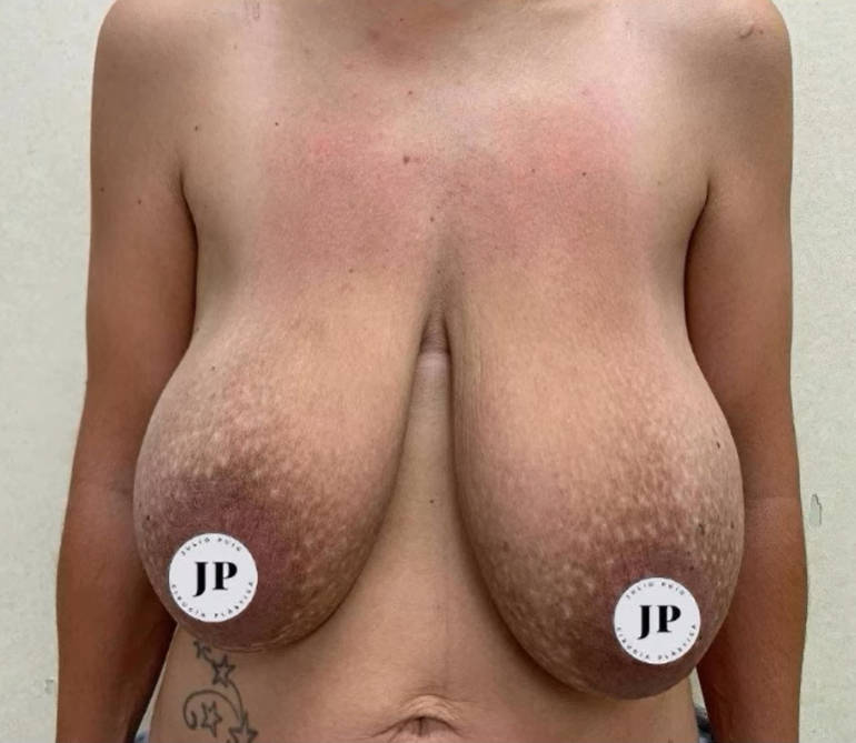 Antes de la reducción de pecho vista frontal