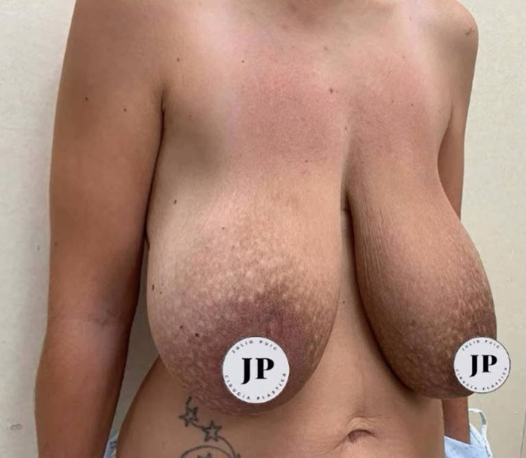 Antes de la reducción de pecho vista perfil