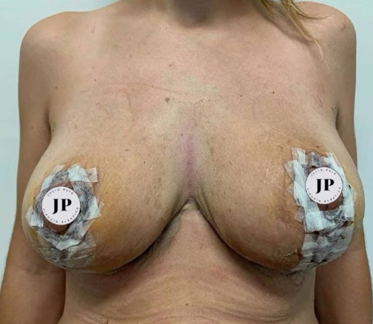 Después de la reducción de pecho frente