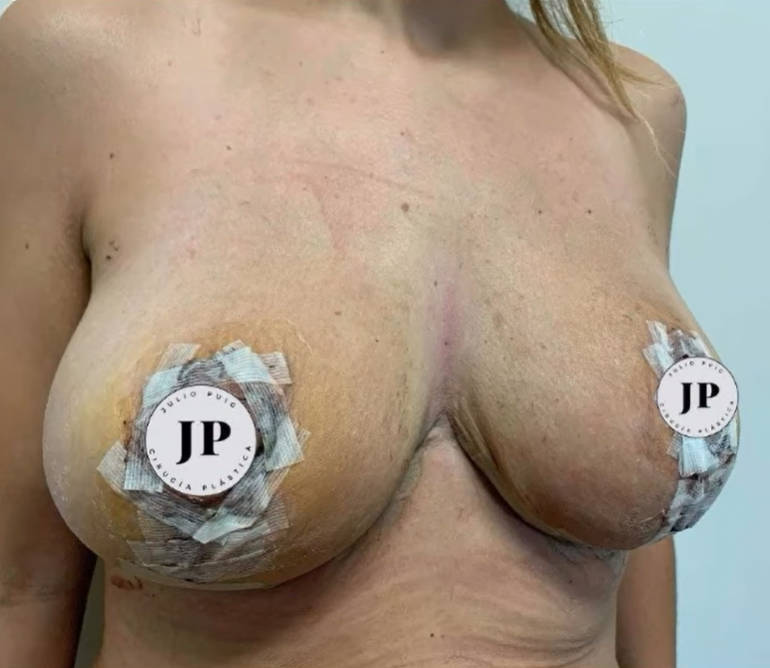 Después de la reducción de pecho vista de perfil