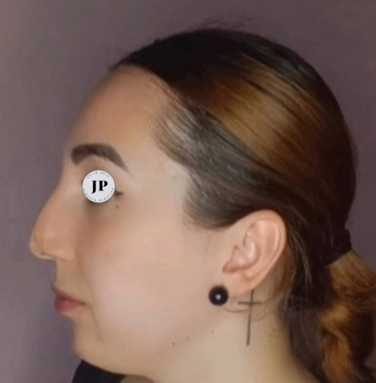 antes de rinoseptoplastia ultrasonica mujer