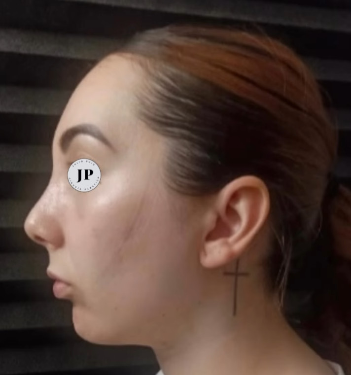 despues de rinoseptoplastia ultrasonica mujer